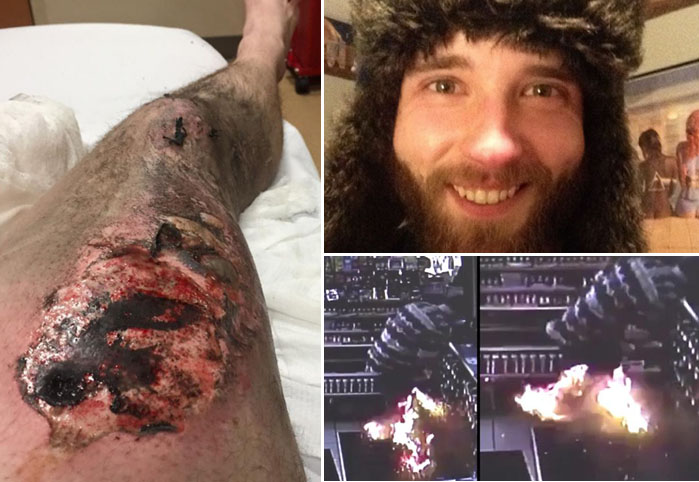 Rokok Elektrik Akibatnya Begini setelah Baterainya Meledak di Saku Celana